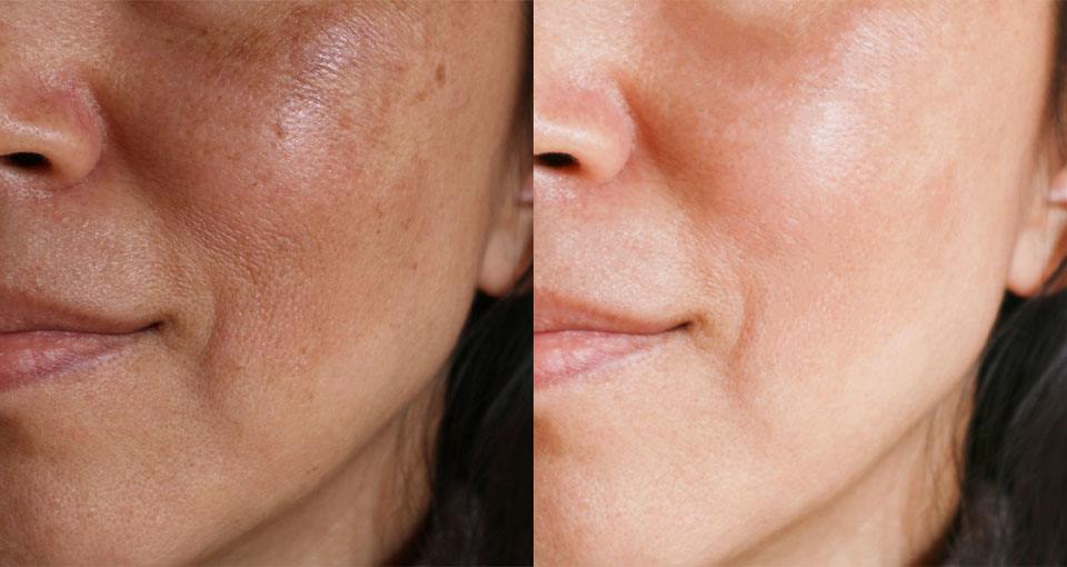 How do you use vitamin C serum for uneven skin tone & dark circles?